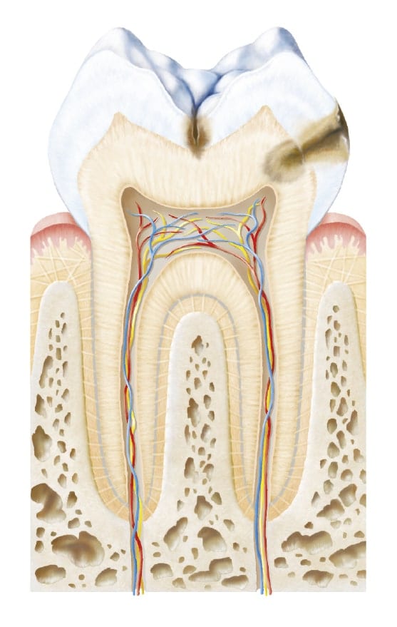 Structure interne d'une dent cariée
